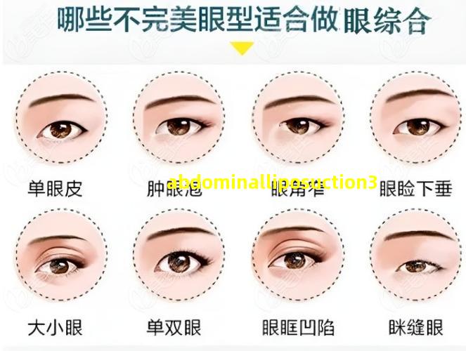 肚子抽脂图片过程图片