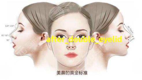做完双眼皮15天后的照片