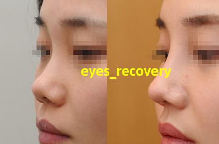 eyes recovery