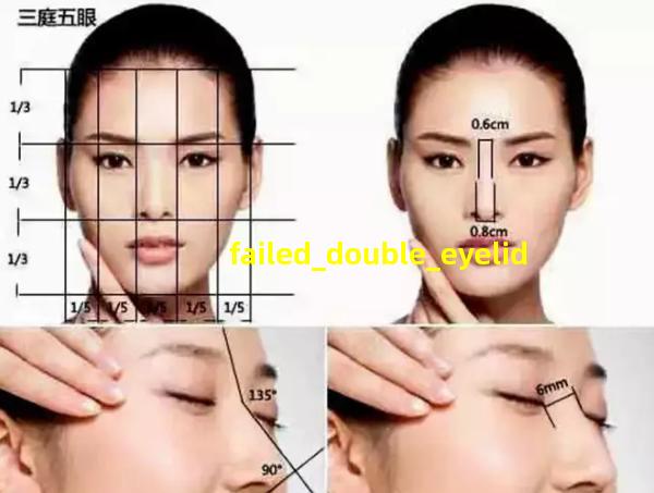 failed_double_eyelid