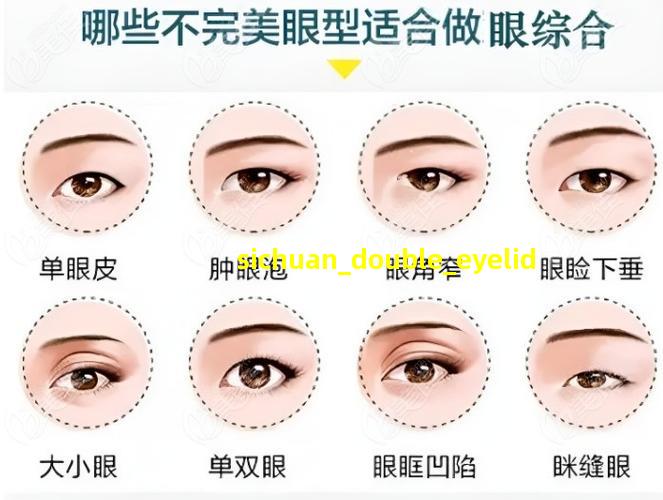 成都双眼皮修复