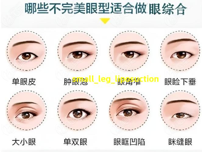 小腿肚子抽脂示意图