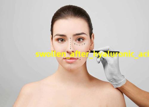 swollen after hyaluronic acid