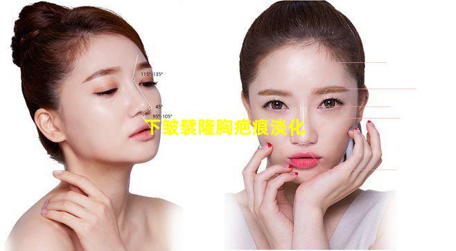 下皱襞隆胸疤痕淡化