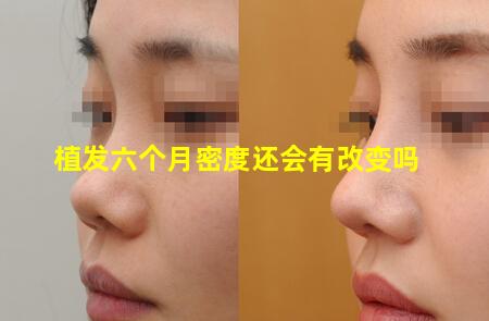 植发六个月密度还会有改变吗