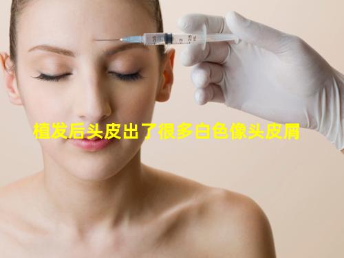 头皮屑