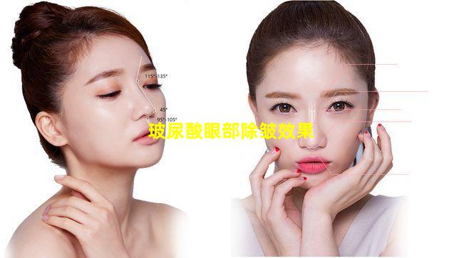 玻尿酸眼部除皱效果