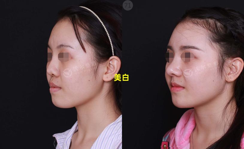 美白丸涂脸真的可以祛斑吗女生