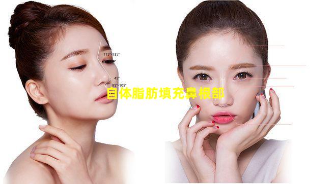 自体脂肪填充鼻根部