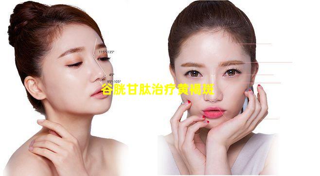 谷胱甘肽治疗黄褐斑